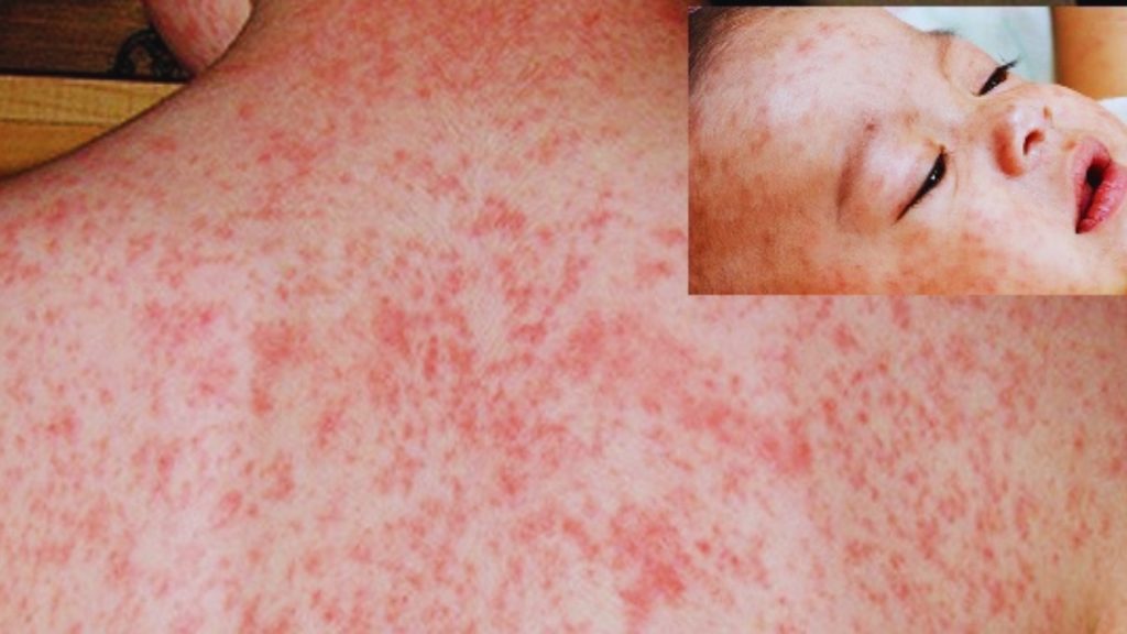 দেশে বাড়ছে হাম রোগী